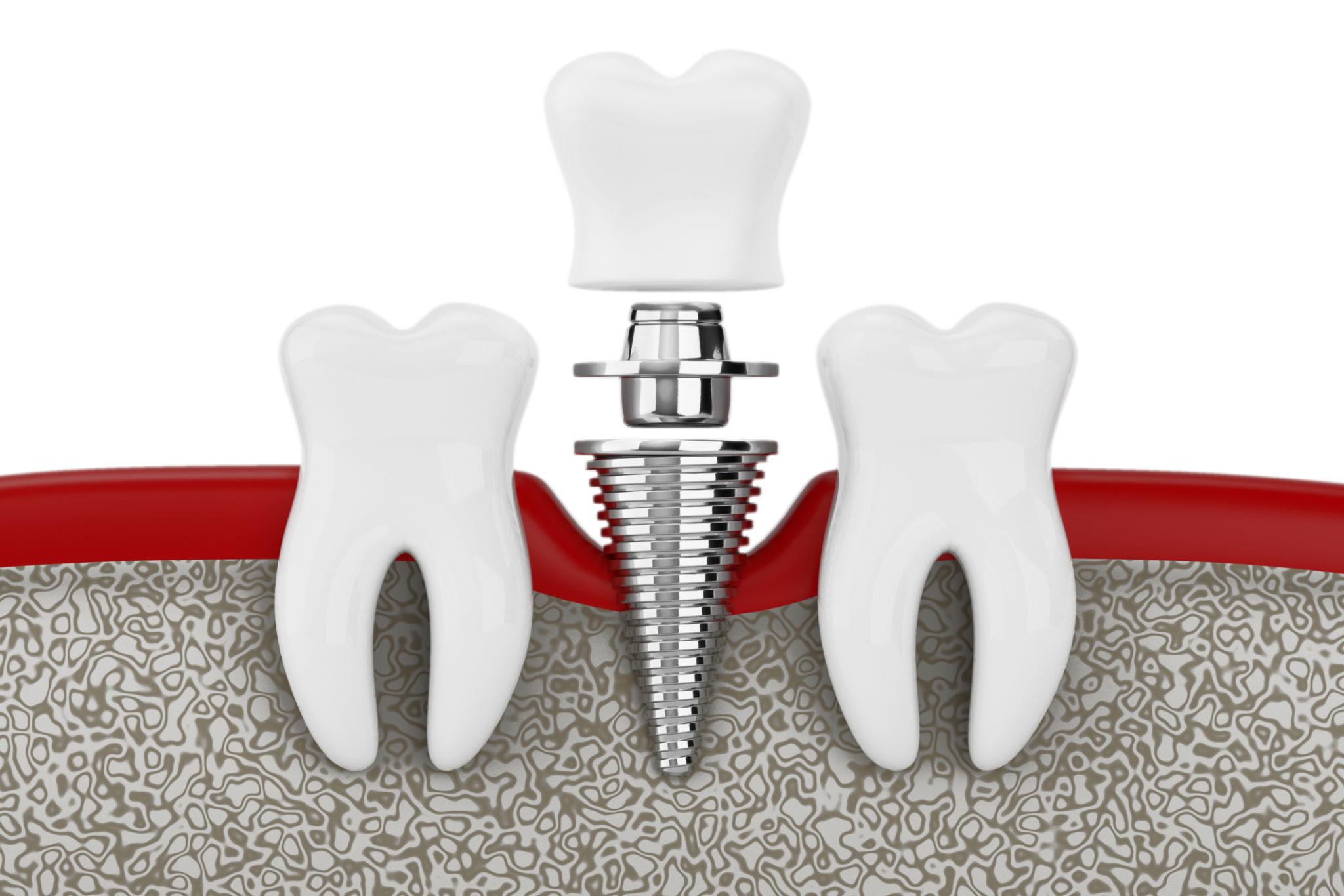 Patient testimonial - Full mouth implant success